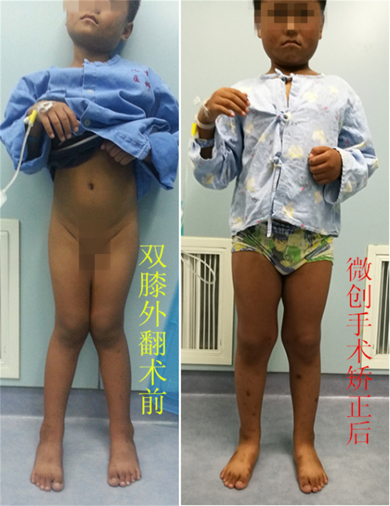 徐州市儿童医院科普：膝内外翻的矫治