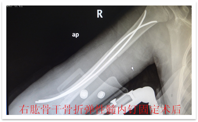 徐州市儿童医院科普：儿童骨折的微创治疗--四肢骨折的弹性髓内钉技术