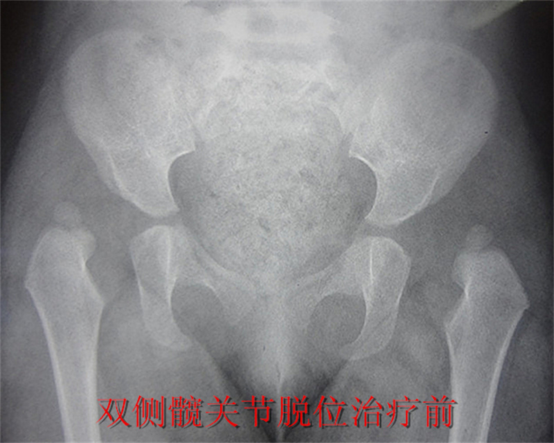 徐州市儿童医院科普：发育性髋关节脱位的早期诊断与治疗
