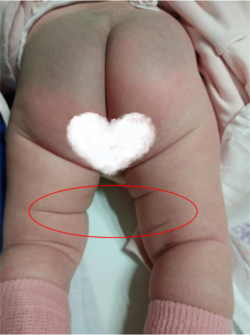 徐州市儿童医院科普：婴幼儿腿纹不对称，超声检查探究竟
